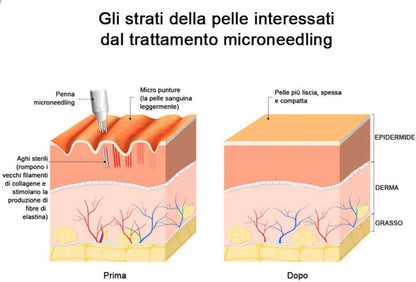 "Penna" microneedling