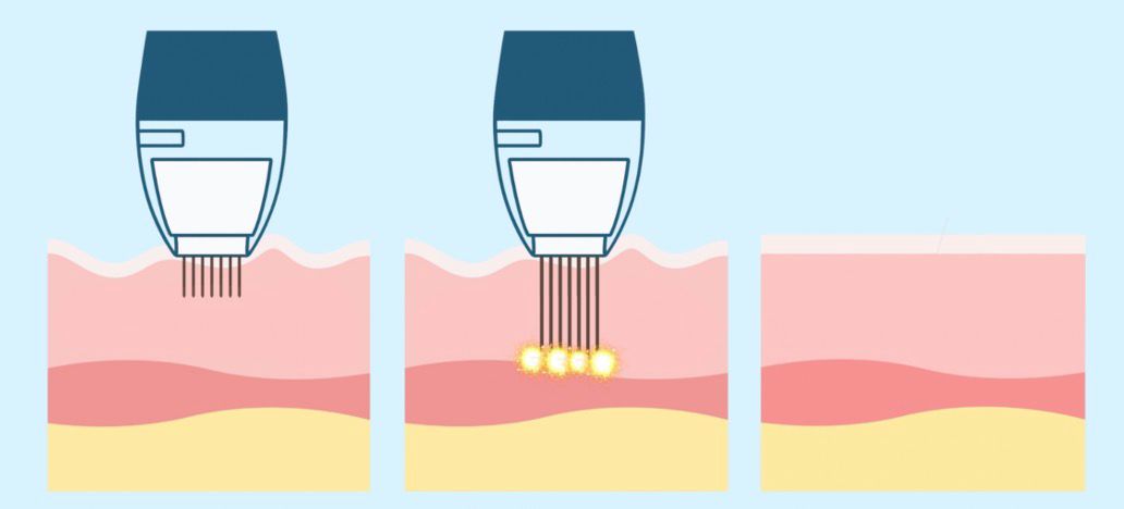 "Penna" microneedling