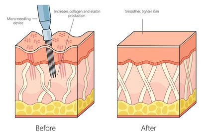 "Penna" microneedling